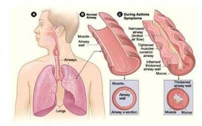 The Asthma Long Term Diseases