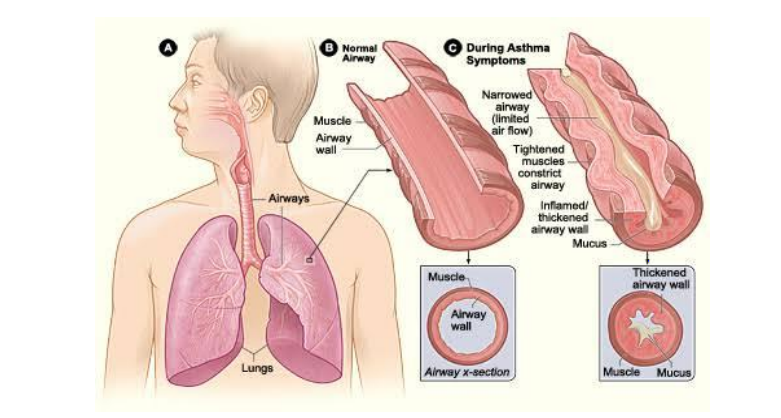 The Asthma Long Term Diseases
